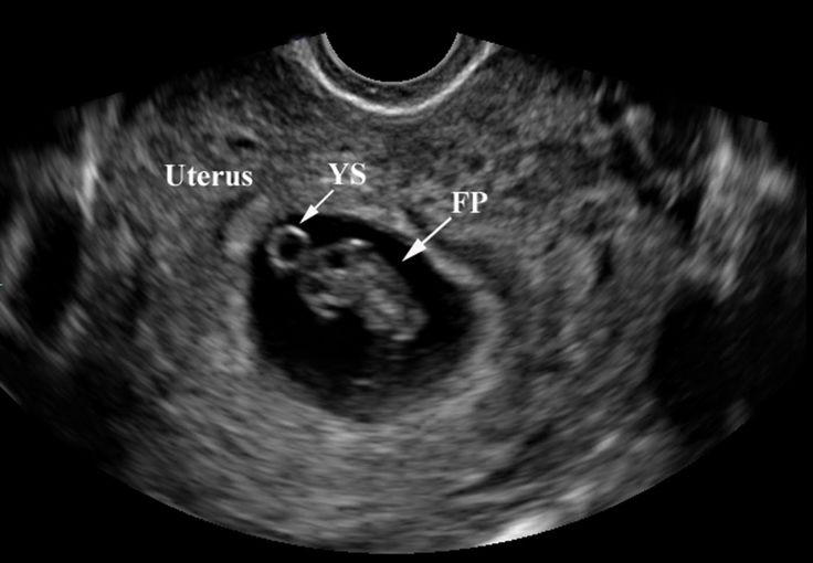 Ultrasound showing uterus, yolk sac, fetal pole.