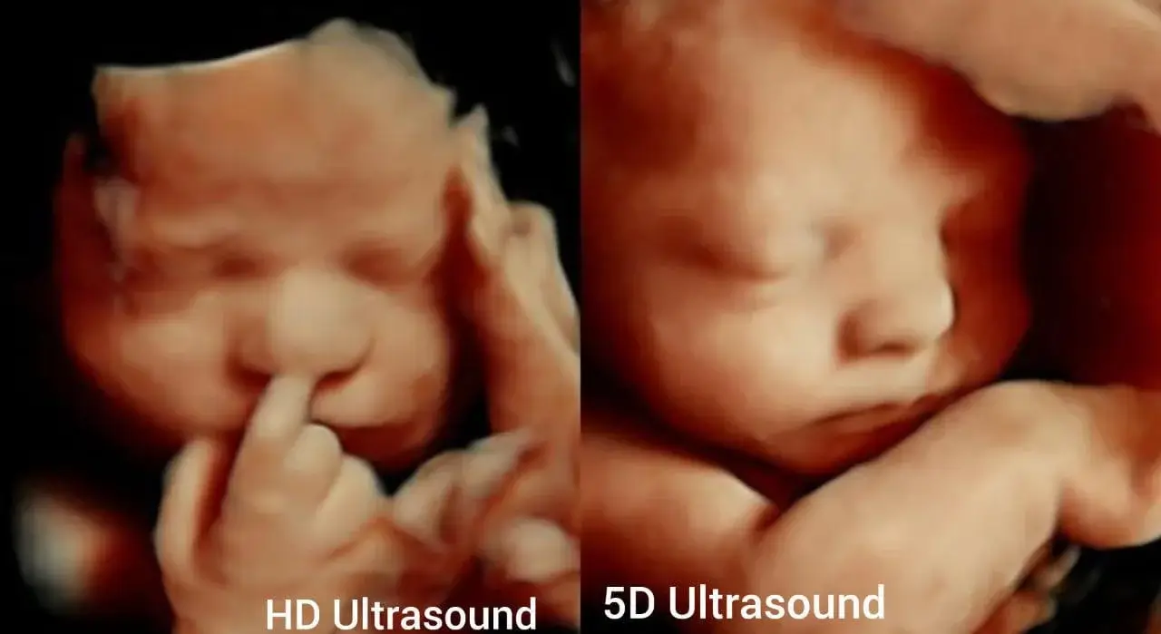 HD and 5D ultrasound images of fetus.